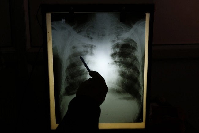 CDC: Tuberculosis Cases Spiking in USA Since 2022. What Else Has Spiked in America Since Then?
