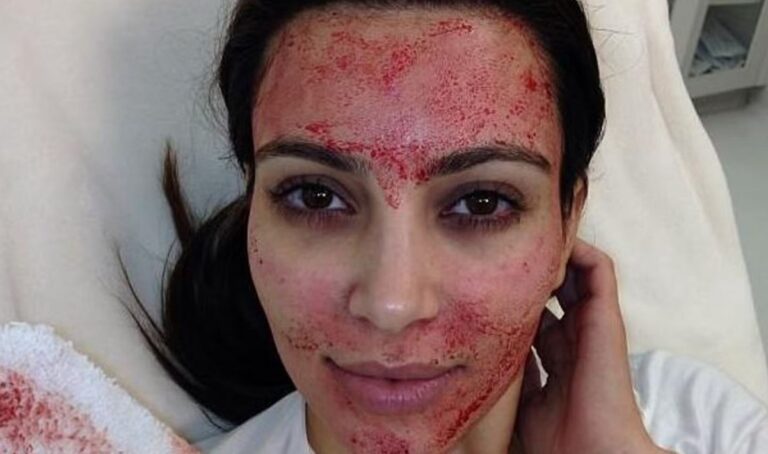 Women Diagnosed With HIV After “Vampire Facial” Procedures Popularized by Kim Kardashian